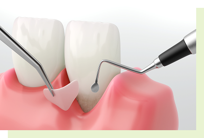 periodontal_image03
